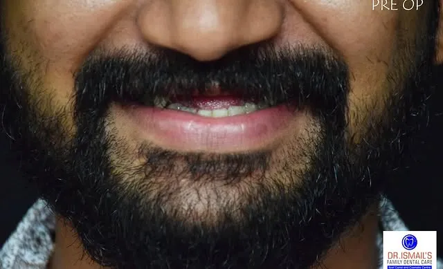Before Transformation 2